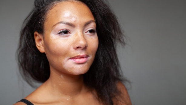 Rencontre régionale du Havre – Association Française du vitiligo