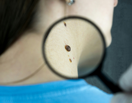 l'importance de la détection précoce et du traitement de la peau