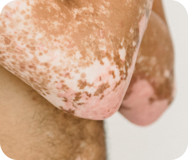 maladie de peau vitiligo