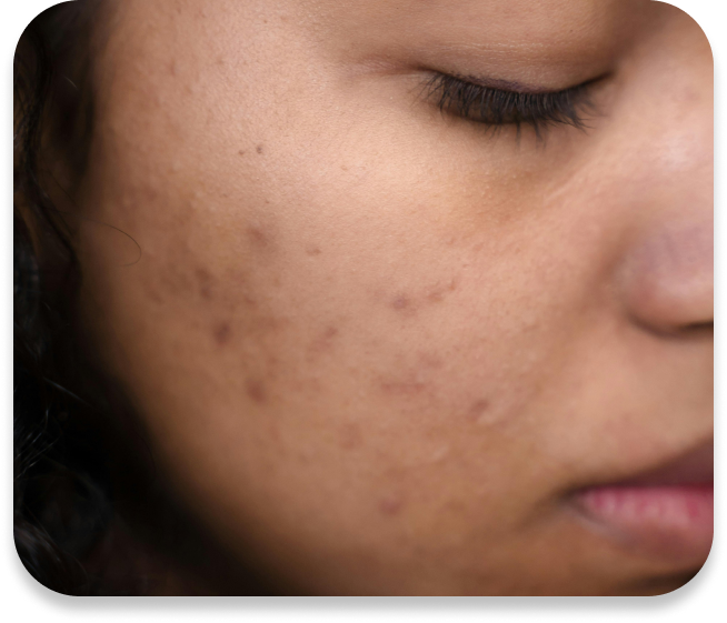 problème de peau acné