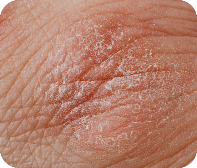 problème de peau eczéma